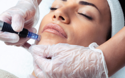 Is Microneedling Worth It?